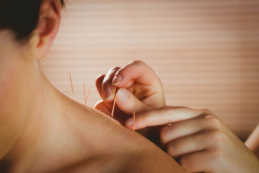 Acupuncture - Drug-free pain management