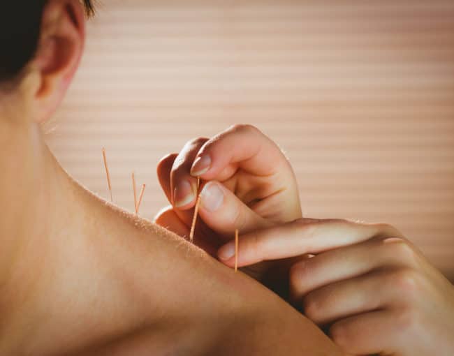 Acupuncture - Drug-free pain management